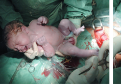 Evidenzbasierte Chirurgie der Schnittentbindung