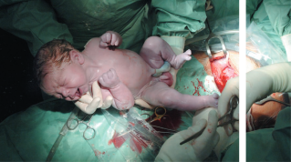 Evidenzbasierte Chirurgie der Schnittentbindung