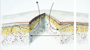 Hautverschluss: So oder so?
