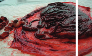 Bakterielle Vaginose (BV) in der Schwangerschaft: Ein Update