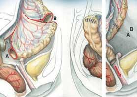 Das MRKH-(Mayer-Rokitansky-Küster-Hauser-)Syndrom