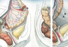 Das MRKH-(Mayer-Rokitansky-Küster-Hauser-)Syndrom