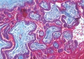 Ist das Präeklampsie-Puzzle gelöst?