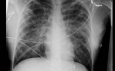 Massive Fruchtwasserembolie