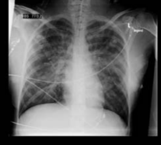 Massive Fruchtwasserembolie