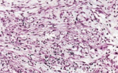 Noduläre Fasziitis der Vulva