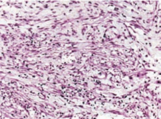 Noduläre Fasziitis der Vulva