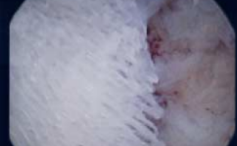 Des Rätsels Lösung: Benigne ossäre Metaplasie des Endometriums