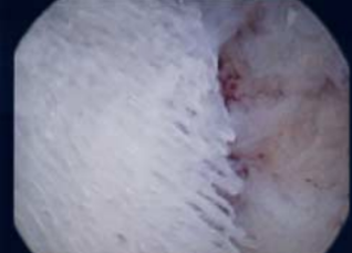 Des Rätsels Lösung: Benigne ossäre Metaplasie des Endometriums