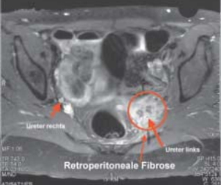 Morbus Ormond (Retroperitoneale Fibrose) im kleinen Becken