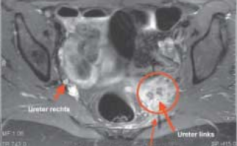 Morbus Ormond (Retroperitoneale Fibrose) im kleinen Becken