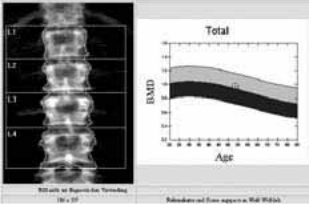 Knochenschutz unter Aromatasehemmern