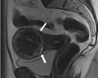 Leiomyom oder Leiomyosarkom des Uterus: Wert der Magnetresonanz-tomographie bei der präoperativen Diagnostik
