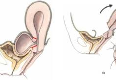 Zur Therapie und Prognose phylloider Tumoren