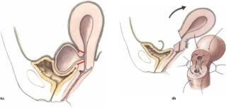 Zur Therapie und Prognose phylloider Tumoren
