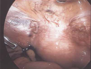 Irreguläre Uterusblutungen und sekundäre Sterilität nach Sectio caesarea