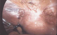 Irreguläre Uterusblutungen und sekundäre Sterilität nach Sectio caesarea