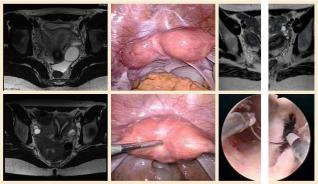 Klinische Bedeutung Müllerschen Fehlbildungen