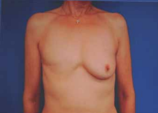 Brustrekonstruktion – ein Update