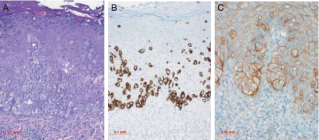 Morbus Paget der Vulva