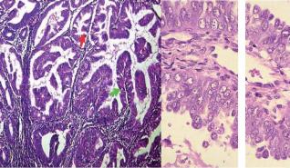 Endometriumkarzinom – Update 2009, Teil 1