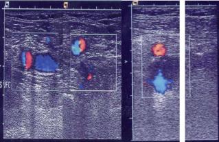 Endometriumkarzinom – Update 2009, Teil 2