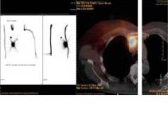 Sentinel-Lymphknoten-Biopsie bei gynäkologischen Malignomen