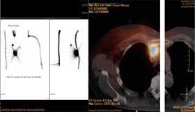 Sentinel-Lymphknoten-Biopsie bei gynäkologischen Malignomen