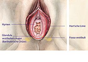 Schmerzhafte Vulva: Vulvodynie, Vestibulitis