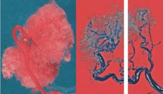 Intrauterine Wachstumsrestriktion