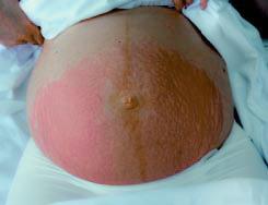 Schwangerschaftsdermatosen