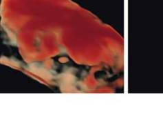 Fetale Therapie Teil 1