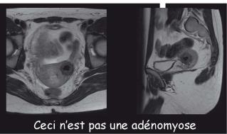 Adenomyose: häufiger als man denkt