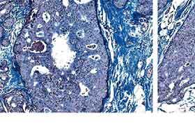 Duktales Carcinoma in situ: Was wissen wir 2017?