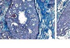 Duktales Carcinoma in situ: Was wissen wir 2017?