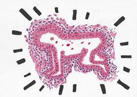 Endometriose und Schwangerschaft: eine herausfordernde Kombination