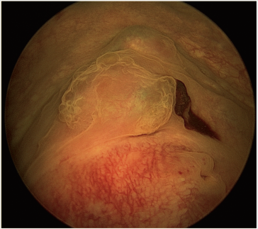 Abb. 2. Blasenendometriose; Patientin präsentiert sich mit menstruationsabhängigen Blasenschmerzen, Dysurie, Hämaturie