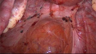 Chronic Pelvic Pain Syndrome – Erfindung oder Realität?