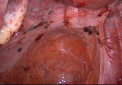 Chronic Pelvic Pain Syndrome – Erfindung oder Realität?