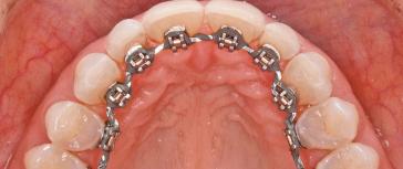 Wie ist es eigentlich, im hohen Alter noch eine Zahnspange zu bekommen?