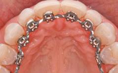 Persönlich – Wie ist es eigentlich, im hohen Alter noch eine Zahnspange zu bekommen?