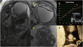 Interhemisphärische Hirnzyste
