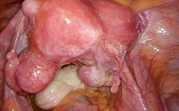 Abb. 1. In der Übersicht stellt sich bereits der im Douglasraum ­liegende Tumor dar.