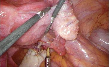 Abb. 2. Nach Mobilisation der rechten Adnexe zeigt sich, dass eindeutig keine Verbindung zwischen rechtem Ovar und dem Tumor im Douglasraum besteht.