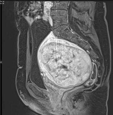 Abb. 1. Sagittale Kontrastmittel-verstärkte MRI Aufnahme des Beckens: Im Bereich der Hinterwand des Uterus zeigt sich eine scharf begrenzte, etwas inhomogen perfundierte Raumforderung, vereinbar mit einem intramuralen, leicht regressiv veränderten Myom. Dieses führt zu einer Impression und Formveränderung der Harnblase. 