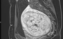 Im Bild – Harnverhalt durch grosses Hinterwandmyom –  Ein der Sakkulation analoger Pathomechanismus
