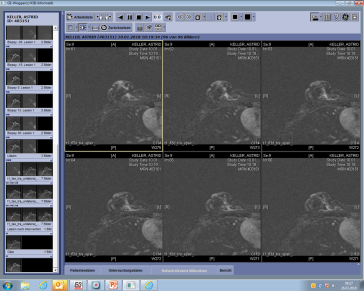 Abb. 4. MRI-gestützte Vakuumbiopsie