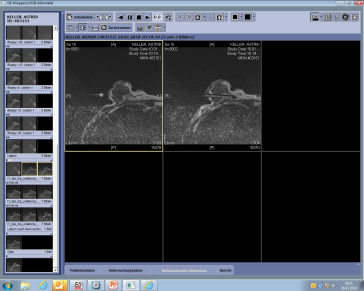 Abb. 5. MRI-gestützte Vakuumbiopsie