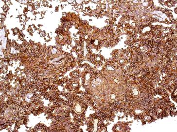 Abb. 6. High-grade-Angiosarkom. Dermal infiltrierende Neo- plasie mit sehr pleomorphen, teils spindeligen Zellen, welche anastomosierende Kanäle und kleine papilläre Formationen bildet (Vergrösserung x200).