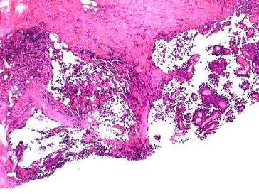 Abb. 7. High-grade-Angiosarkom. Diffuse immunhistochemi- sche Expression der Tumorformationen für den vaskulären Marker CD31 (Vergrösserung x200).